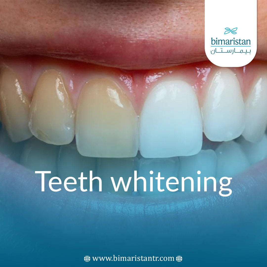 Types Of Teeth Whitening