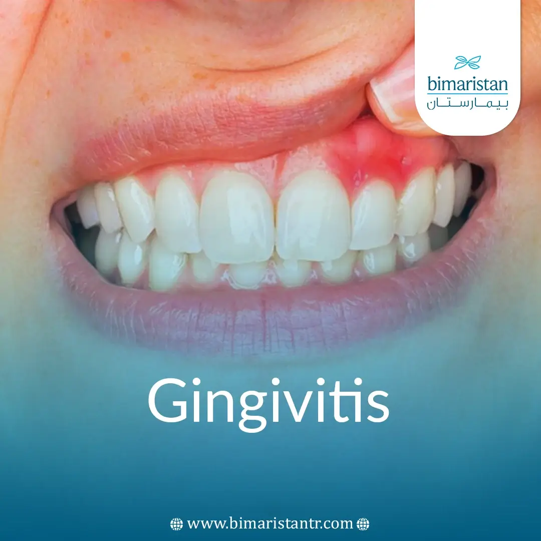 Gingivitis: Everything You Need To Know About Treating Inflamed Gums