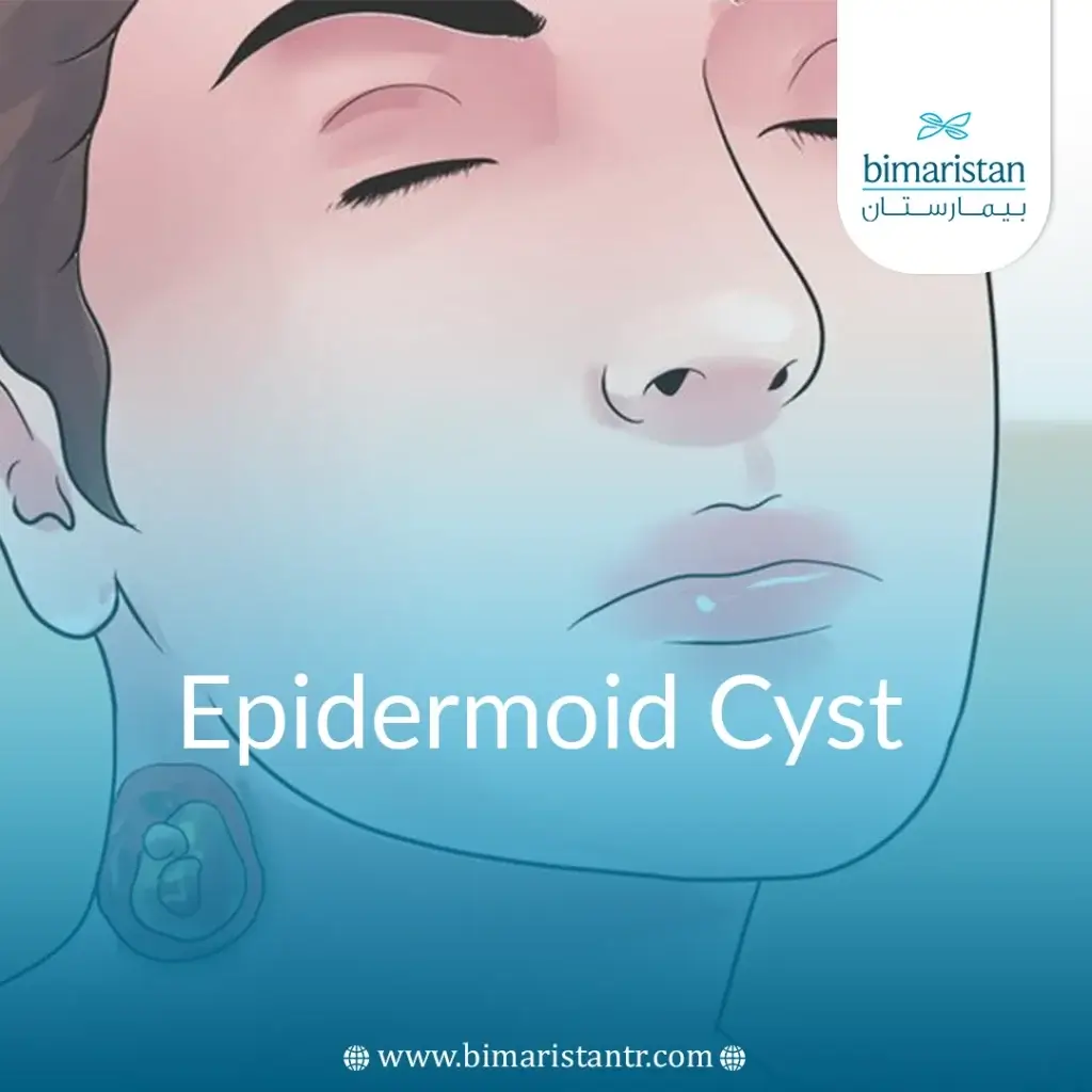 Epidermoid Cyst