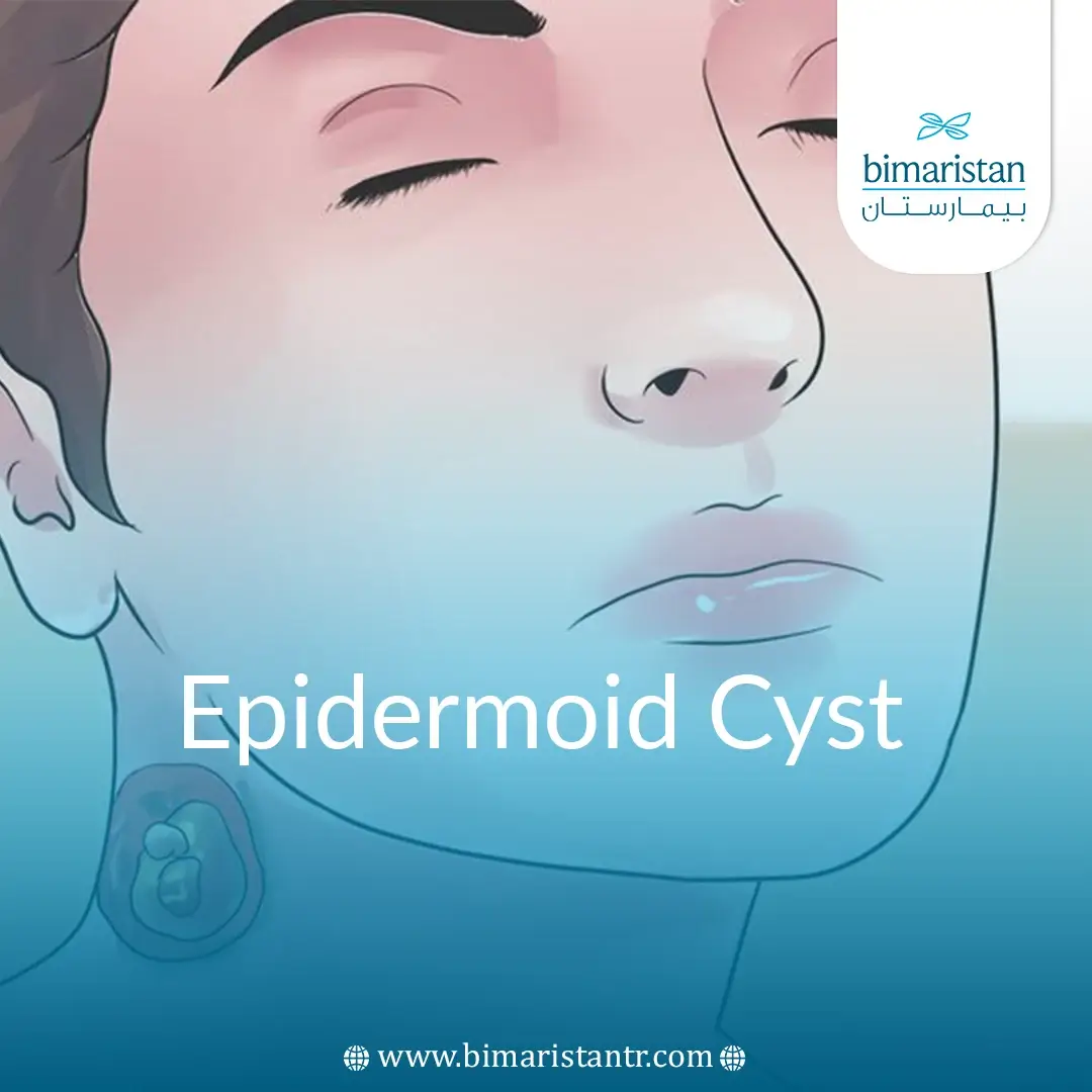 Causes And Symptoms Of Epidermoid Cyst