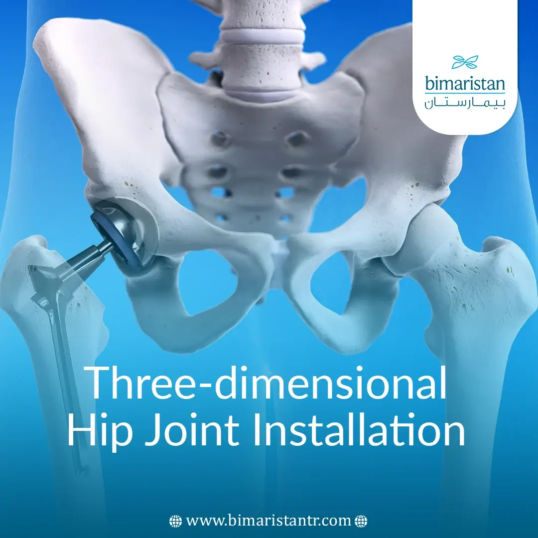 Three-Dimensional Hip Joint Installation