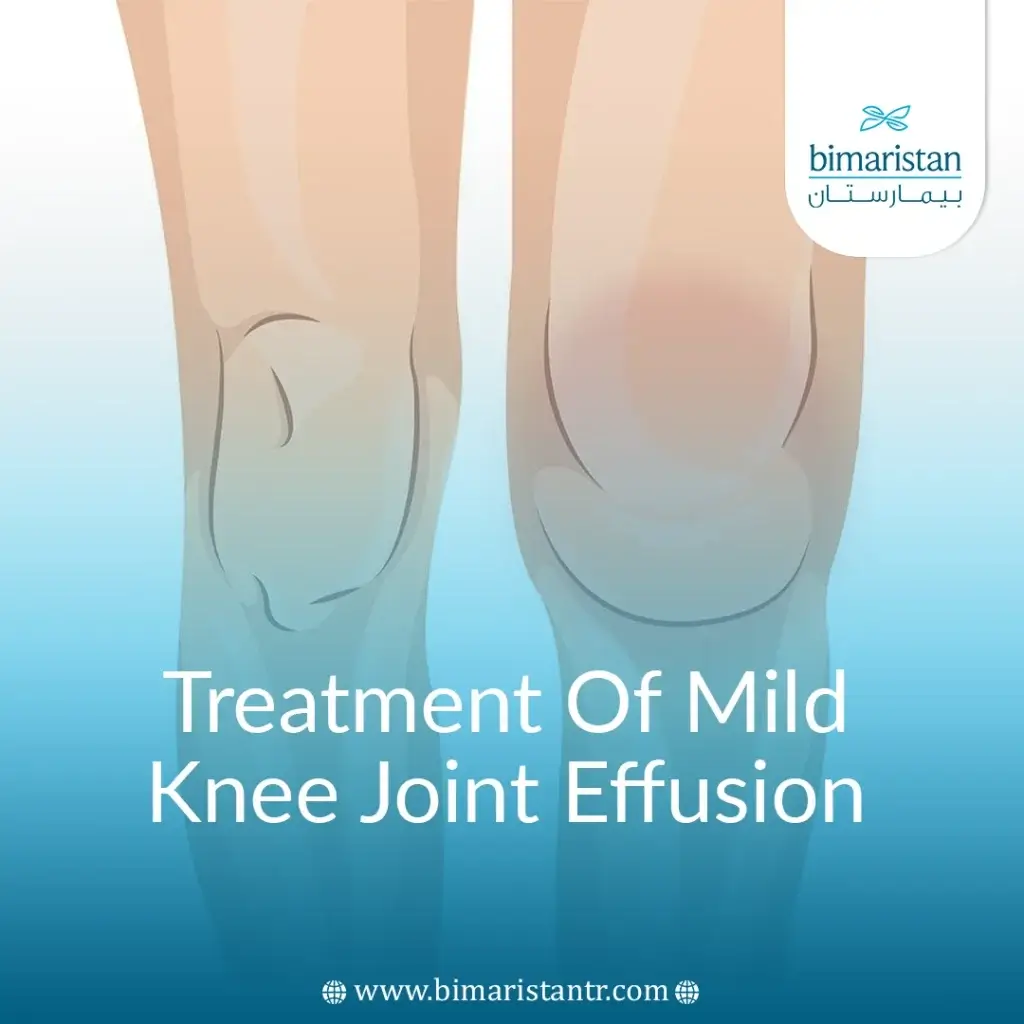 Treatment Of Mild Knee Joint Effusion