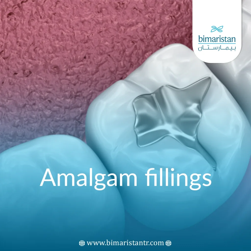 Dental Amalgam Fillings