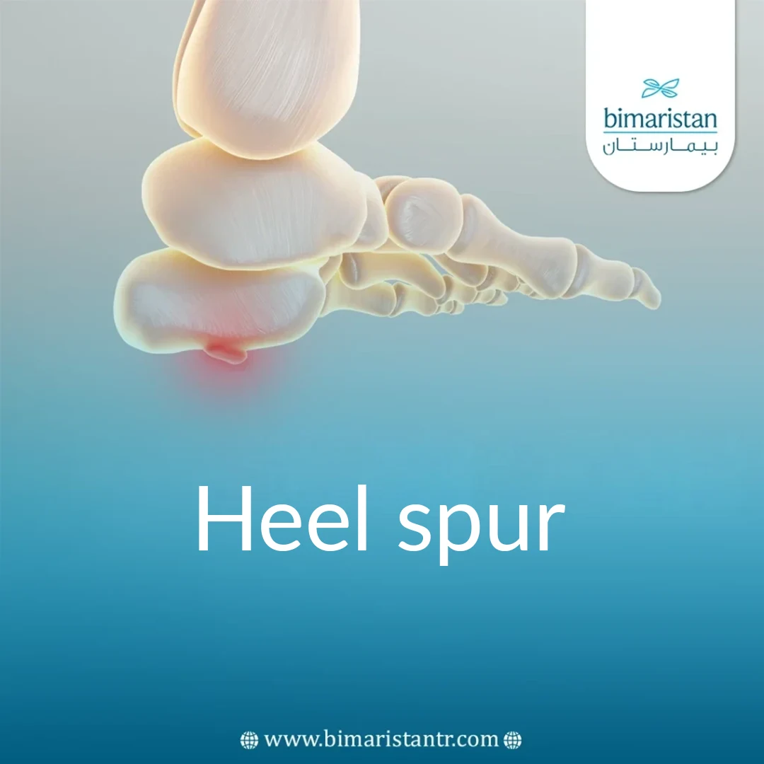 Cover Image About Heel Spurs