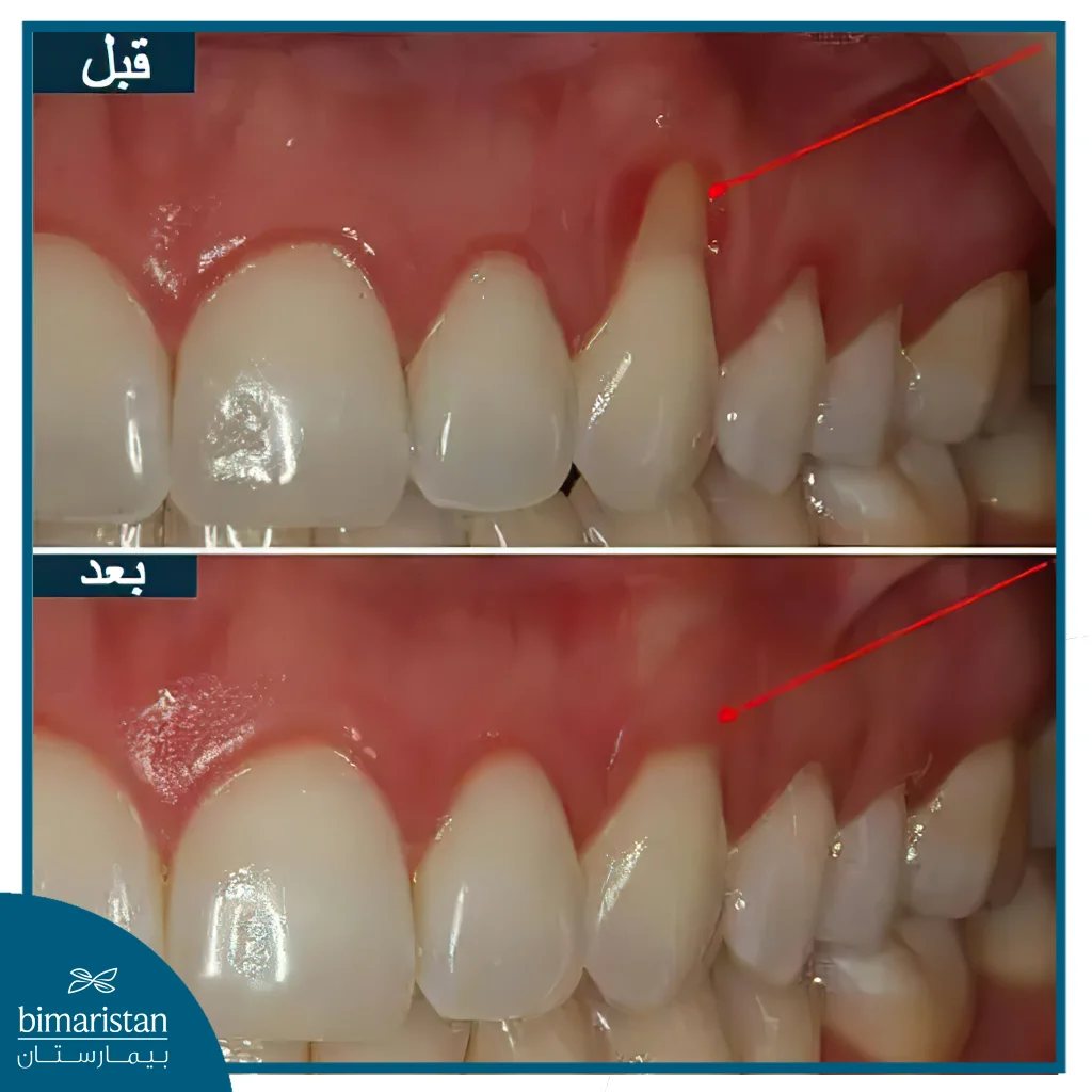 علاج تراجع اللثة في تركيا