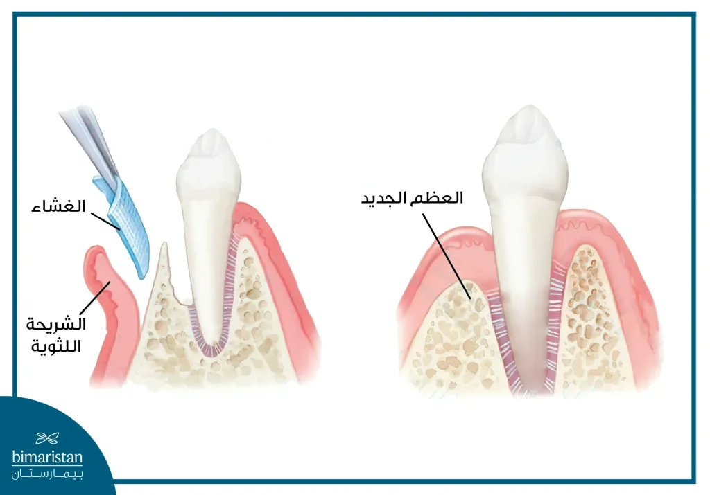 جراحة تجديد الأنسجة الموجه Gtr في تركيا