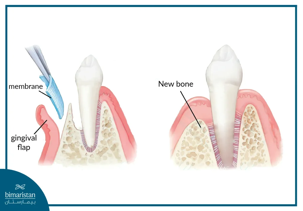 Guided Tissue Regeneration Surgery (Gtr) In Turkey