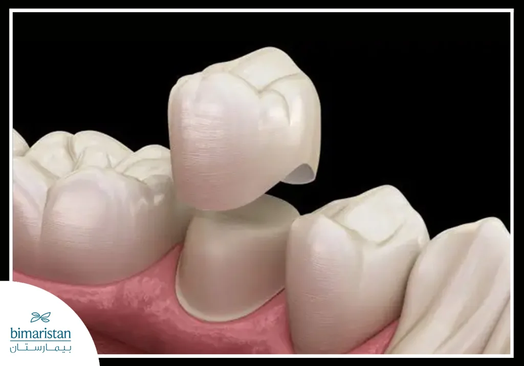 Dental Crowns Installation In Istanbul