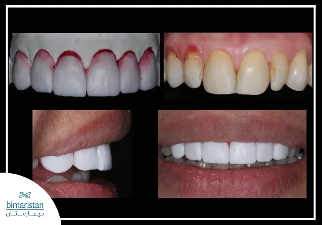 The Picture Shows The Unaesthetic Color Of The Dental Crown Due To Its Poor Quality