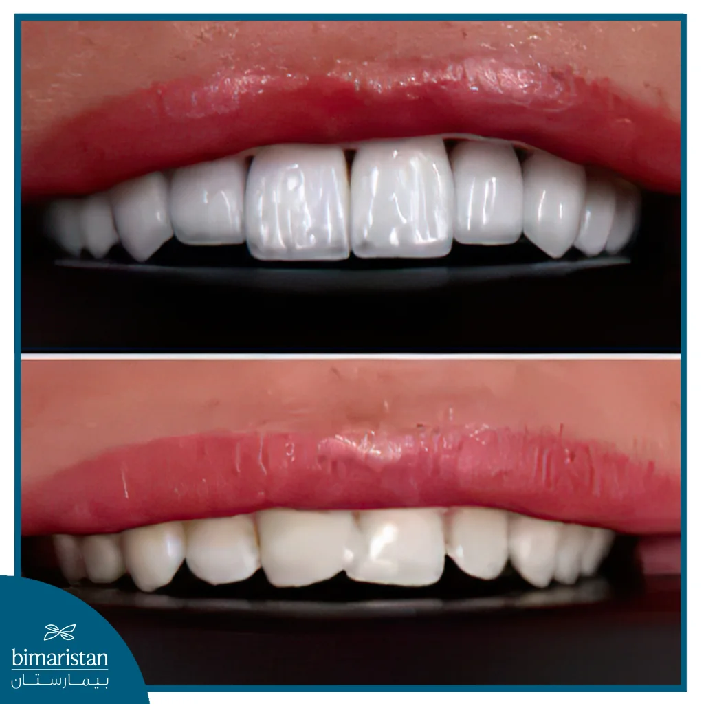 Teeth Shape In Good Types Of Veneers And Crowns