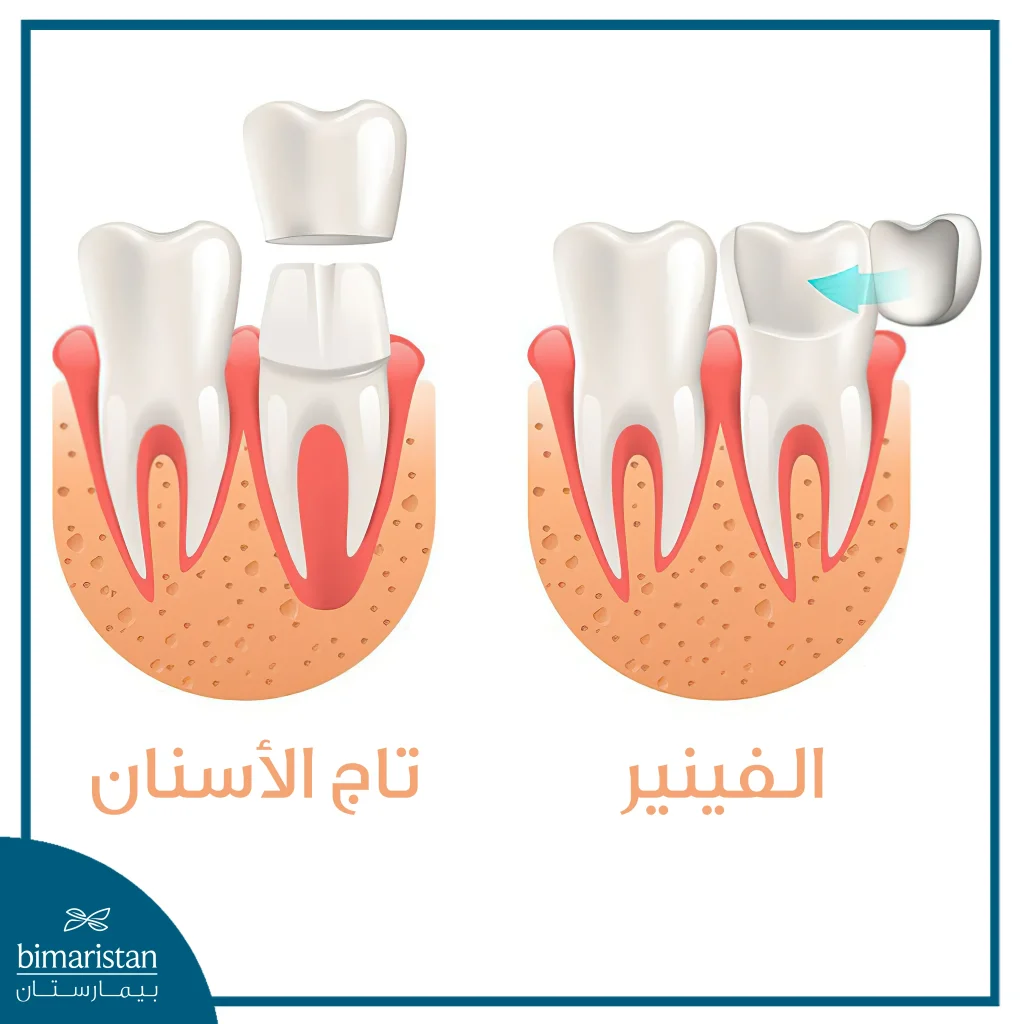 الفرق بين التاج أو التلبيسة والفينير