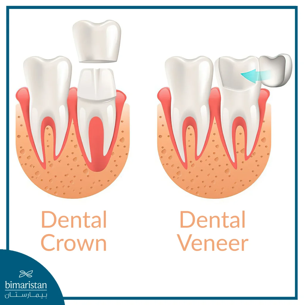 The Difference Between Veneers And Crowns