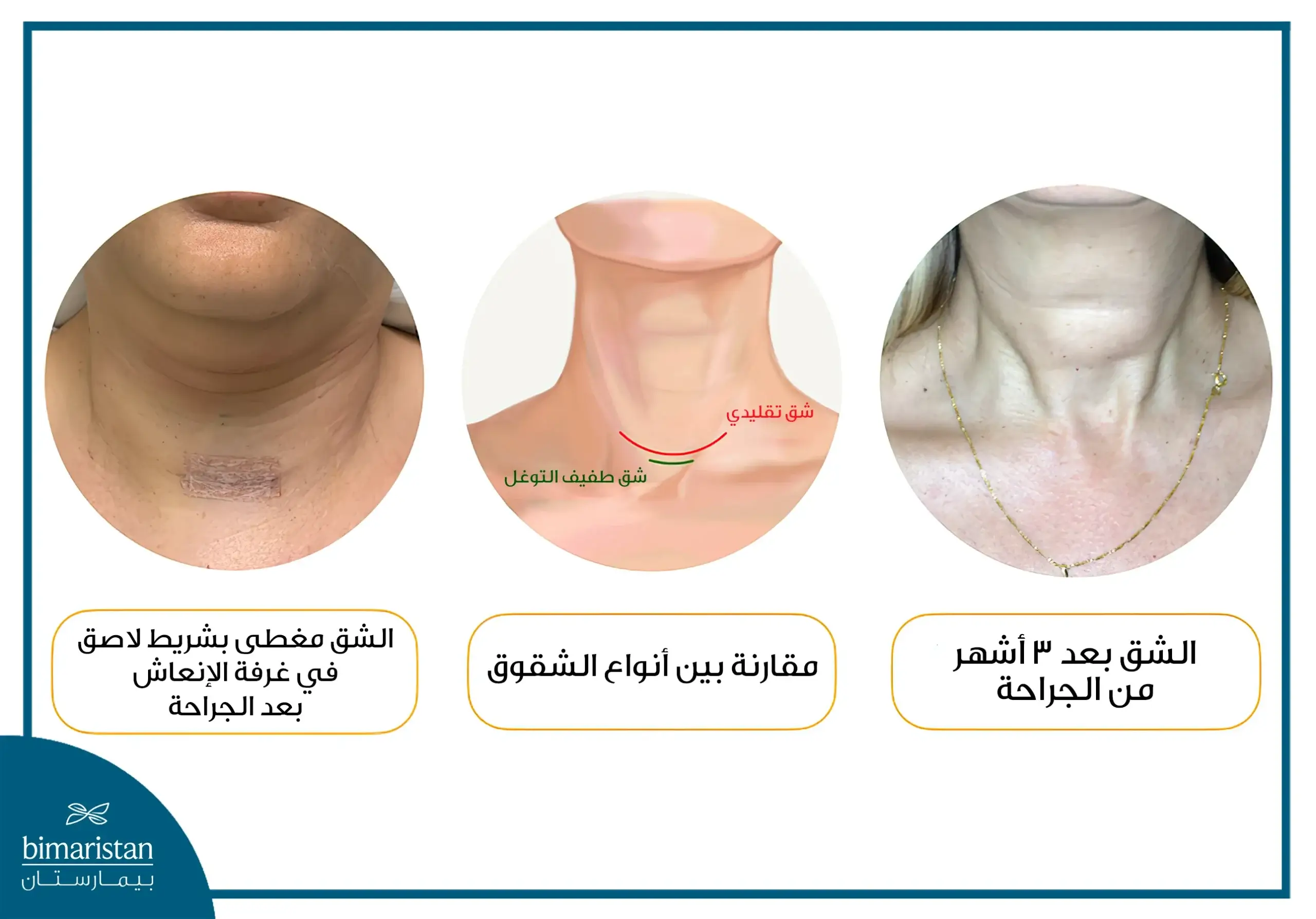 شكل الرقبة بعد عملية الغدة الدرقية