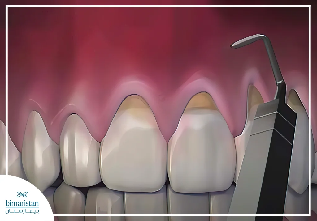 Periodontal Surgery