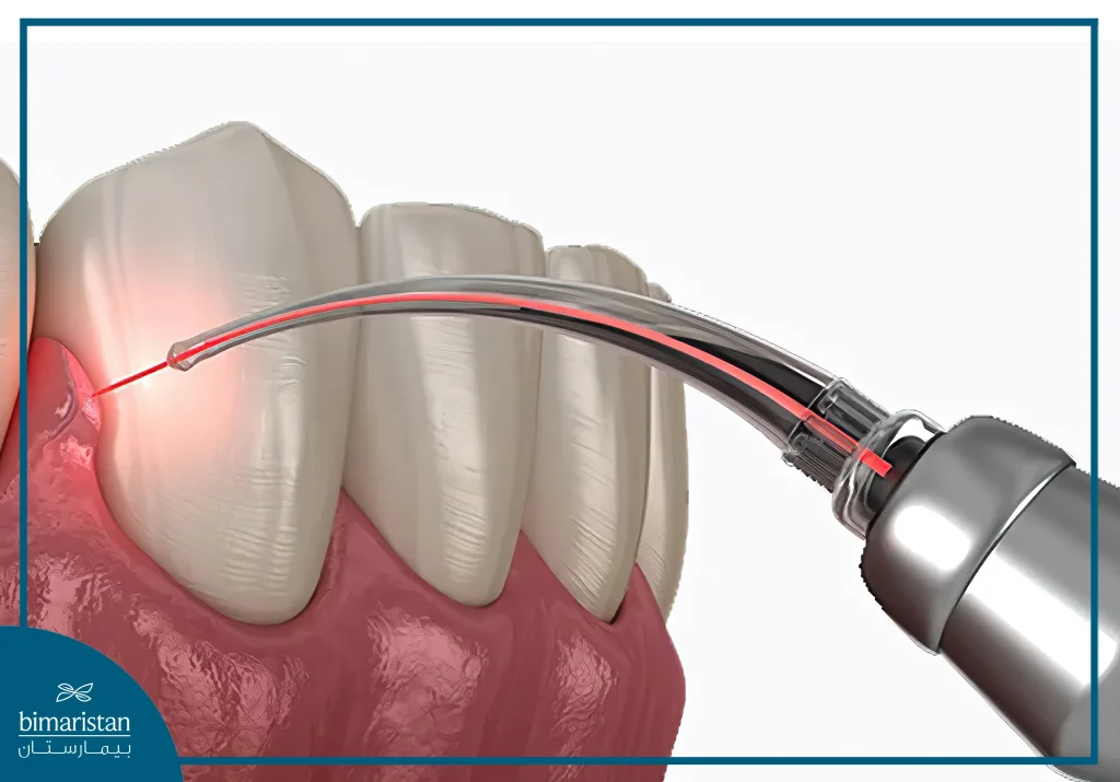 Laser Gum Surgery In Turkey