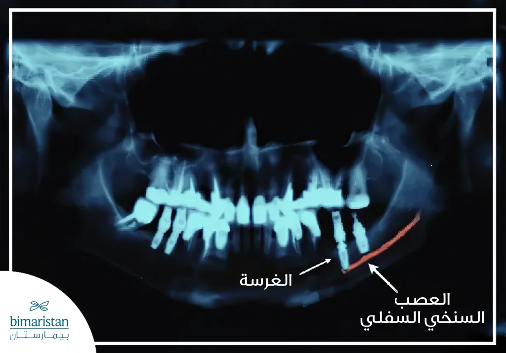 نلاحظ في الصورة قرب الغرسة الشديد من العصب السنخي السفلي و الذي يسبب أذية للعصب