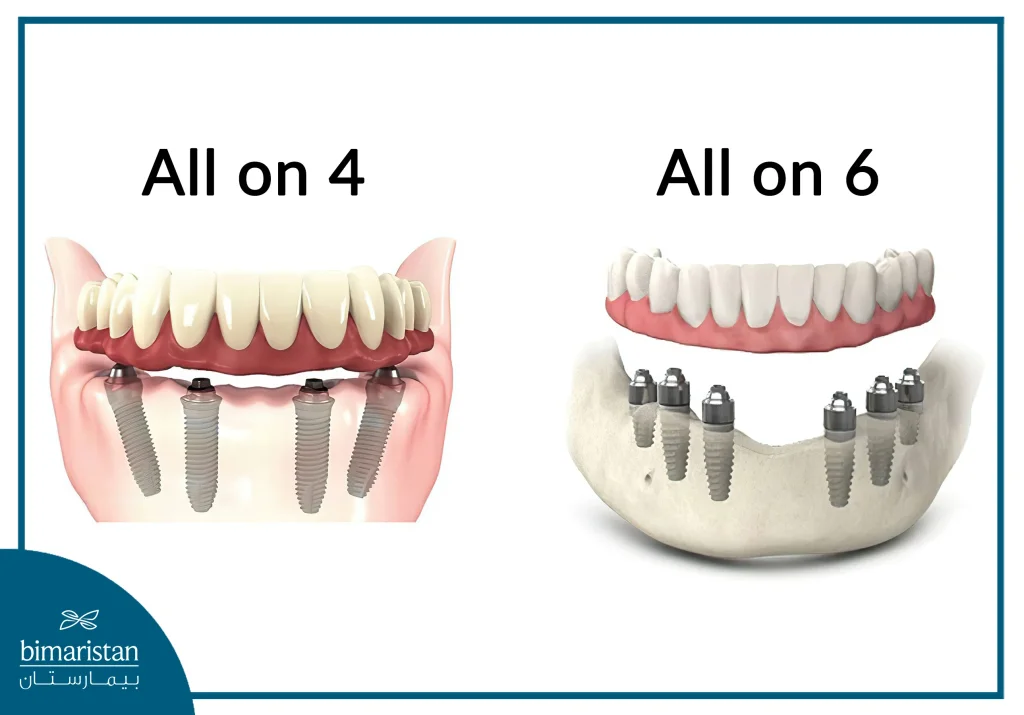 We Notice In The Picture The Difference Between The Placement Of Implants In Both The All On 6 And All On 4 Techniques