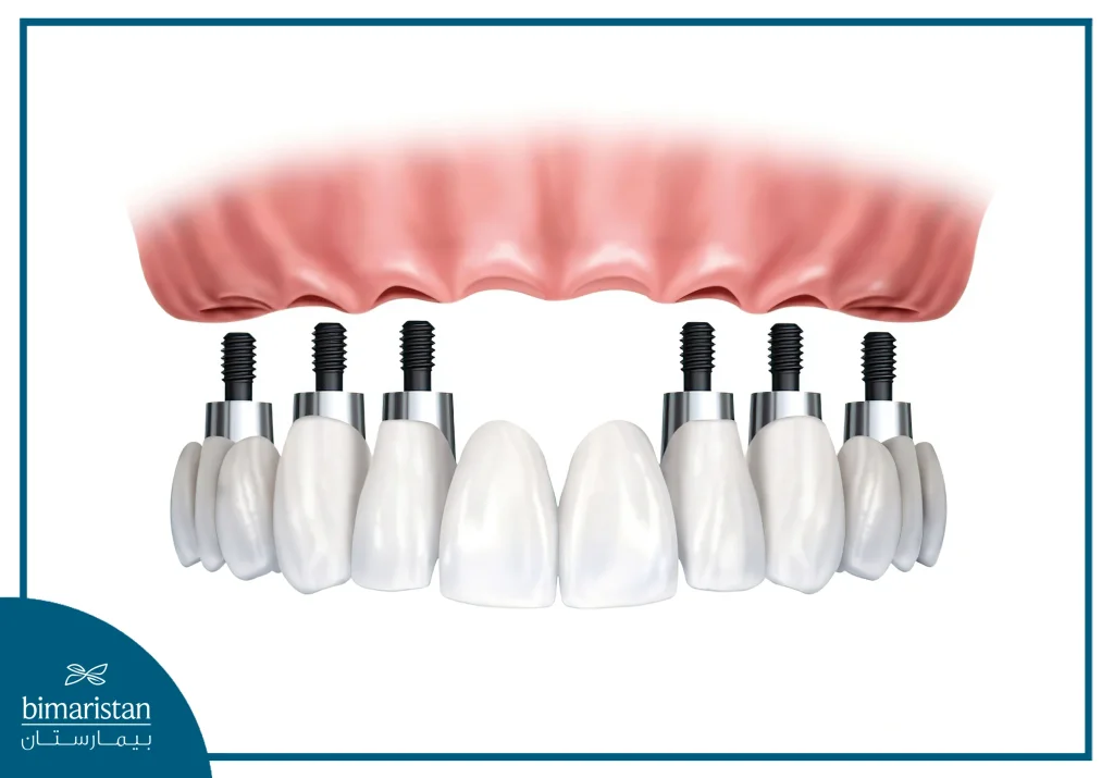 We Notice In The Picture The Placement Of Dental Implants Using The All On 6 Dental Implants And The Fixed Bridge On Top Of Them.