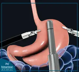 Tools Used In Robotic Bariatric Surgery In Turkey