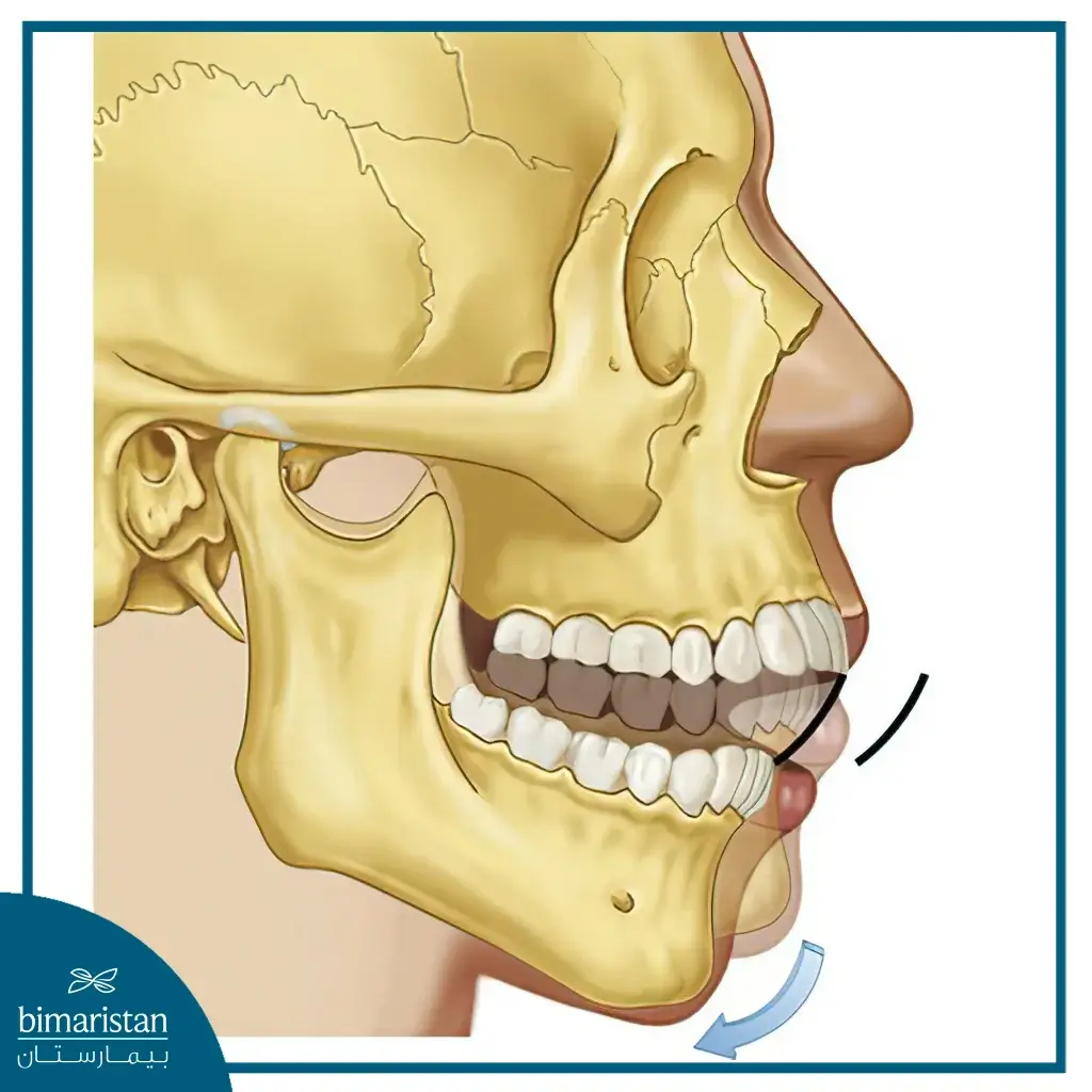 Deviations And Contractures In The Jaw Bones