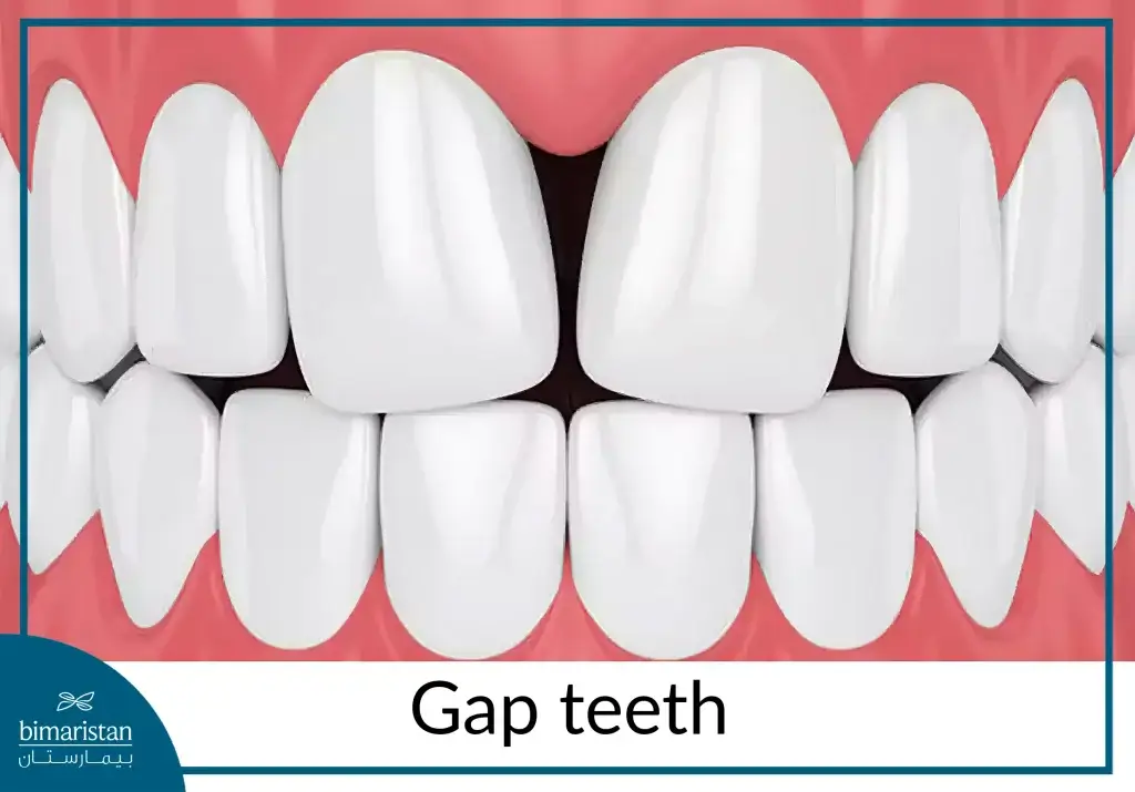 Gap Teeth