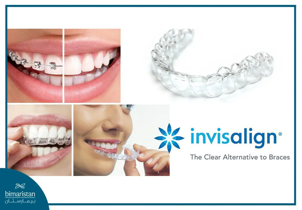 Invisalign: Clear Removable Aligners