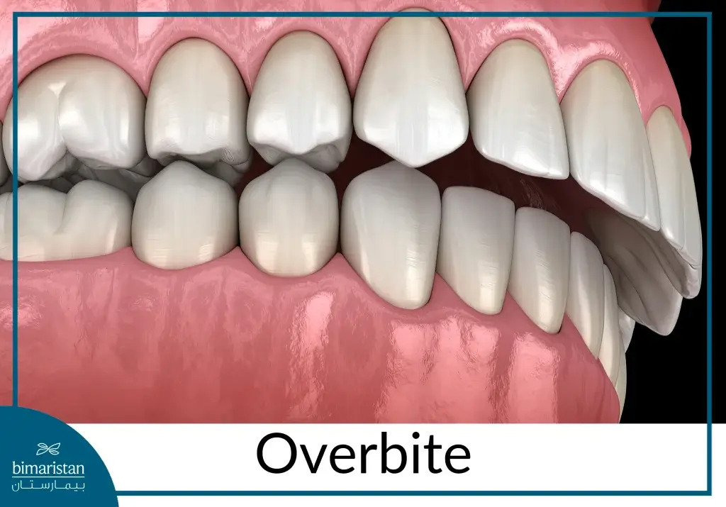 Overbite