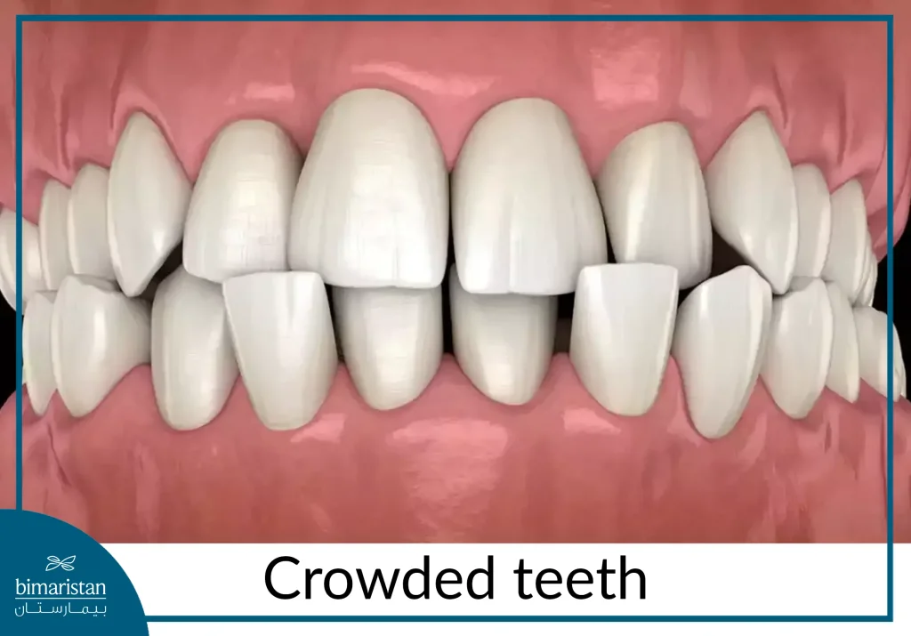 Crowded Teeth