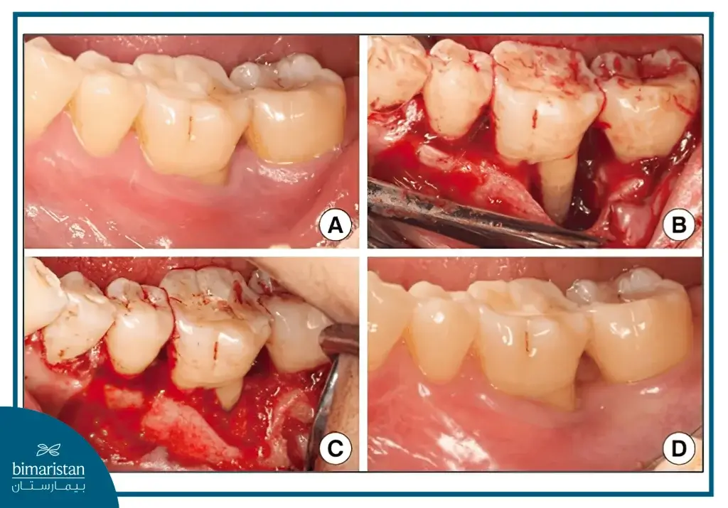 Oral Flap Lift Surgery - Non-Surgical Dental Implants