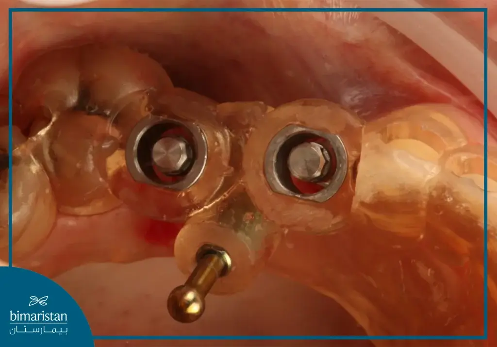 Mucosal-Assisted Surgical Guide