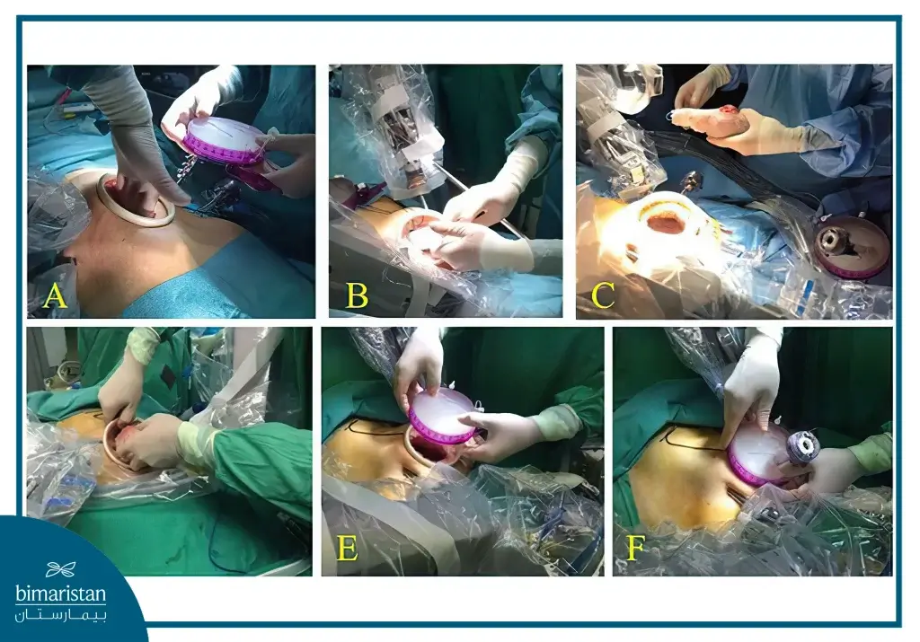 Illustrative Image Of The First Stages Of A Robotic Kidney Transplant