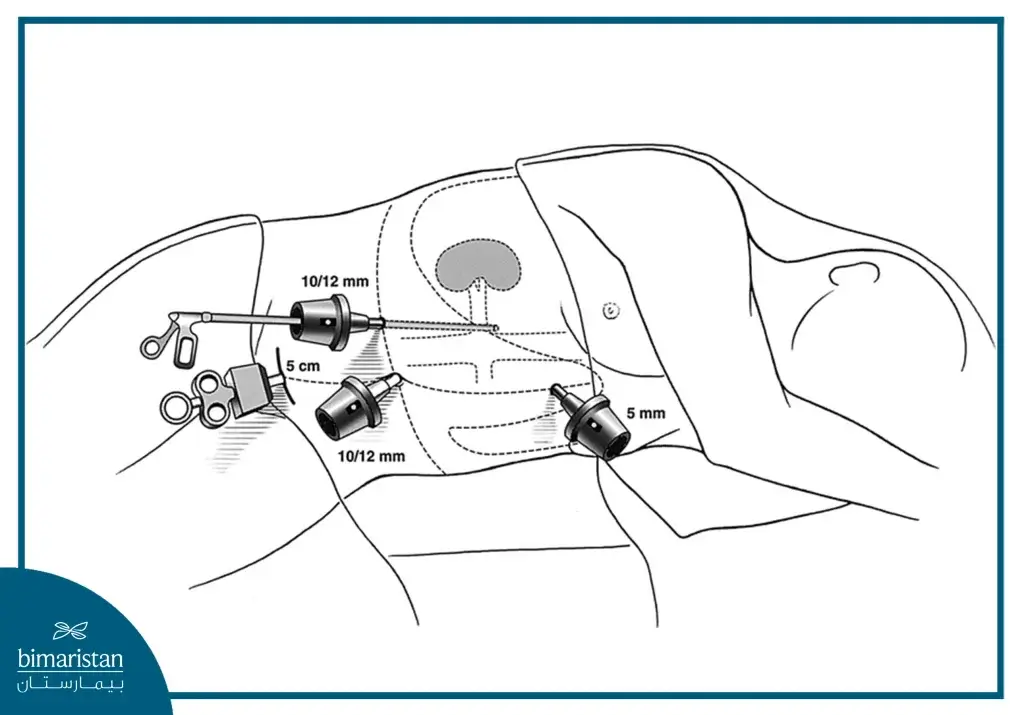 How To Take A Kidney During A Kidney Transplant