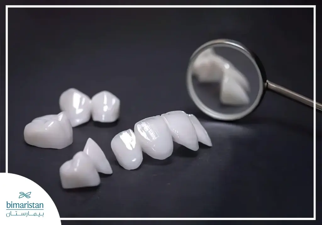 Dental Veneers For Treating Mild Protruding Teeth