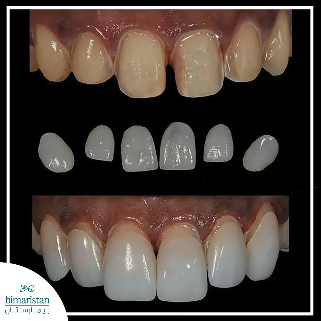 The Picture Shows How The Teeth Look After Dental Veneers