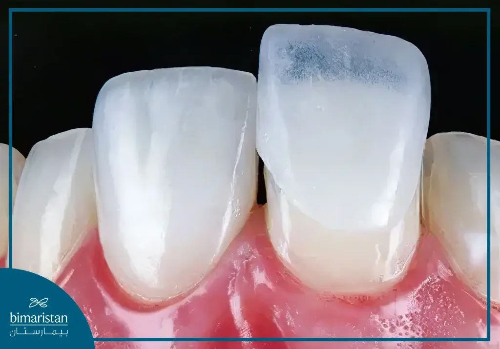 Dental Veneers Installation In Turkey