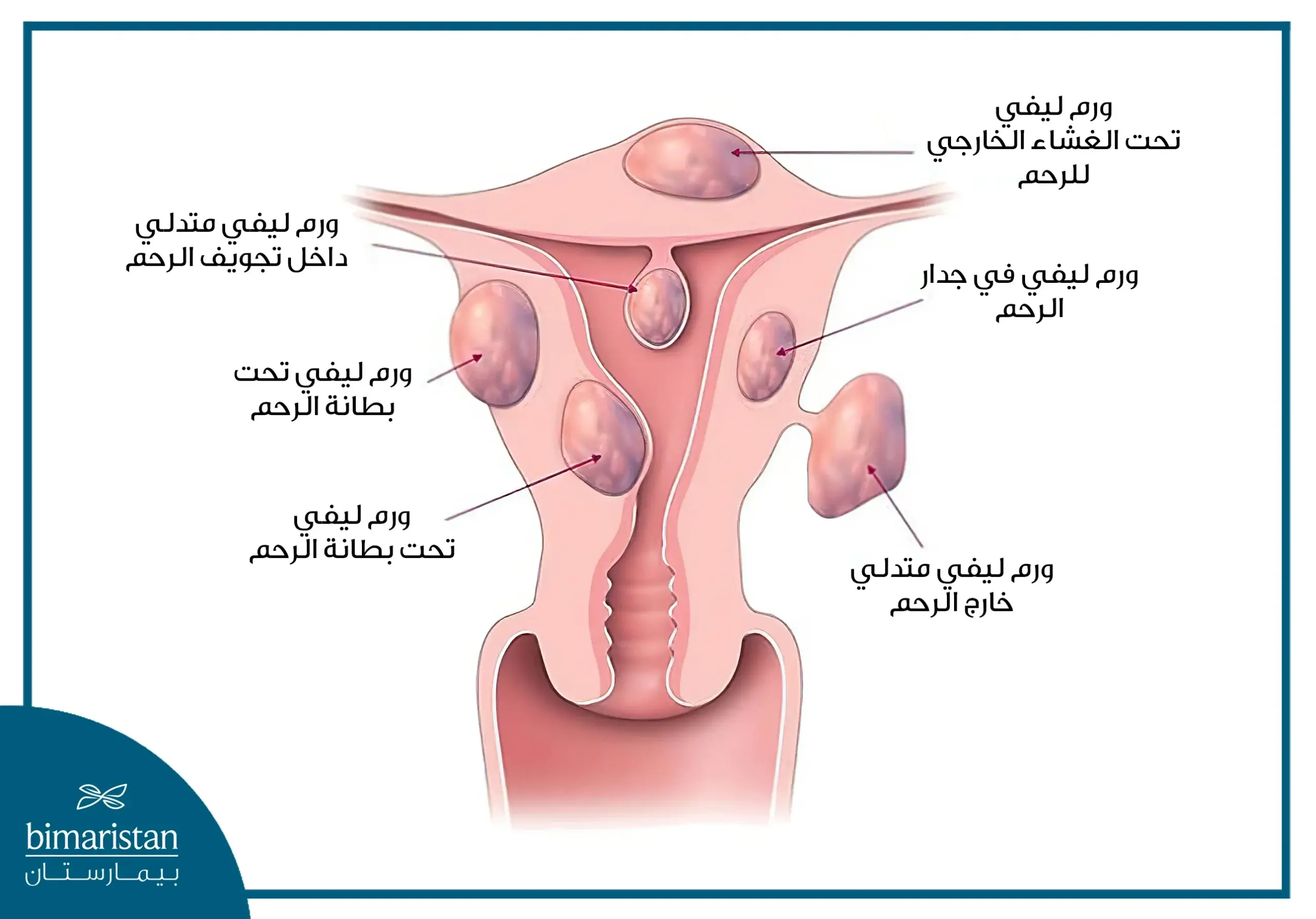 صورة تبين الأنواع المختلفة للأورام الرحمية الليفية ومكان توضعها