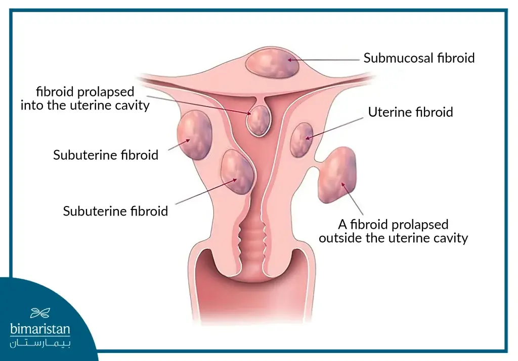 Image Showing The Different Types Of Uterine Fibroids And Where They Are Located