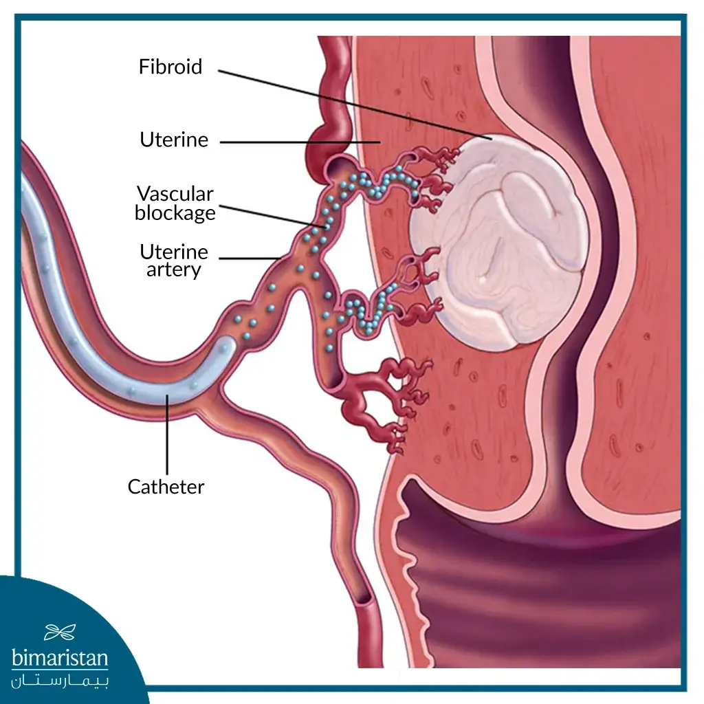 Image Showing Coagulation And Occlusion Of The Artery Feeding The Uterine Fibroid By Catheter