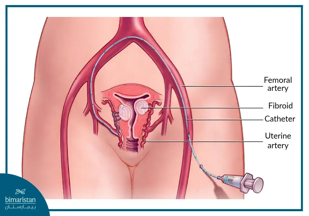 Uterine Fibroid Catheterization