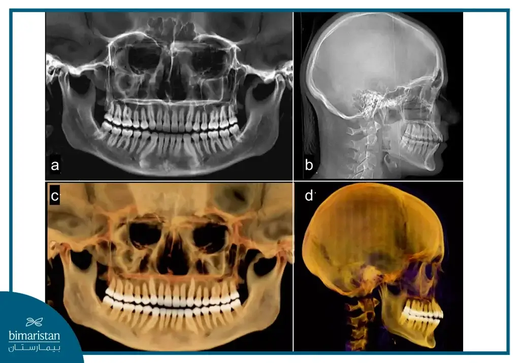 Comparison Between Panoramic Image And Ct Image