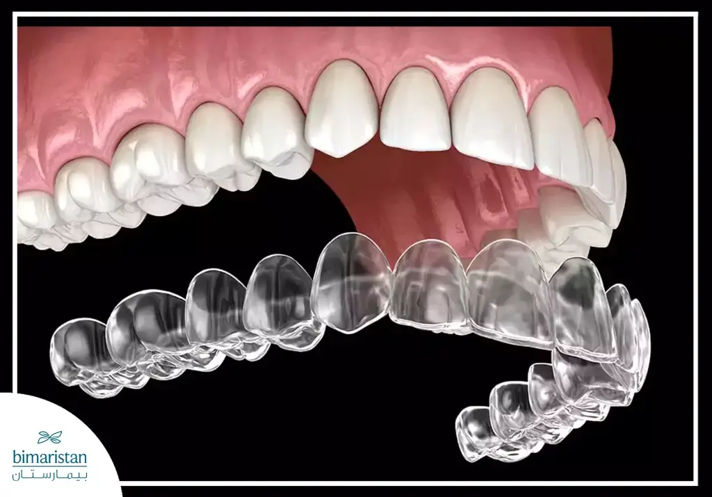 Clear Aligners In Dentistry