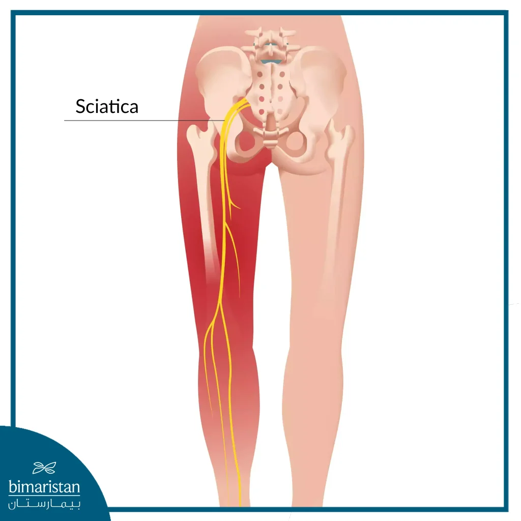 Sciatica Pain Extends Along The Sciatic Nerve