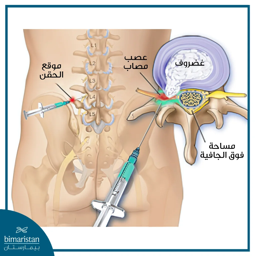 حقن الستيرئد في العمود الفقري القطني في تركيا لتدبير ألم الساق وأسفل الظهر