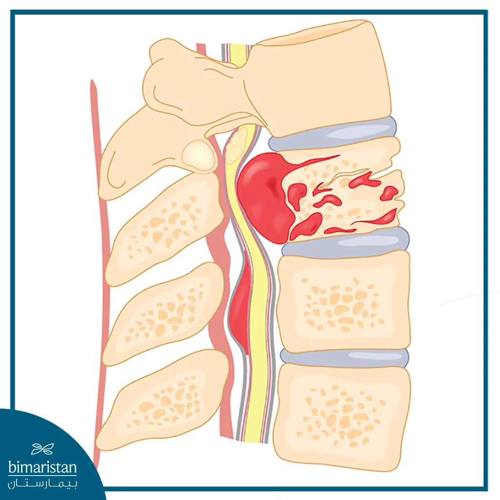 In This Image We See Degenerative Disc Disease Where The Disc Space Collapses And Bone Spurs Grow.