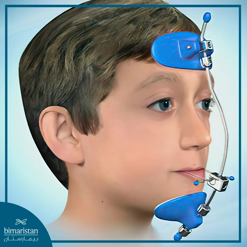 Chin Restraint For Underbite Treatment In Turkey