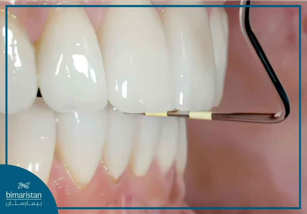 The Probe Shows That The Distance Between The Front And Lower Teeth Is Greater Than 2 Mm