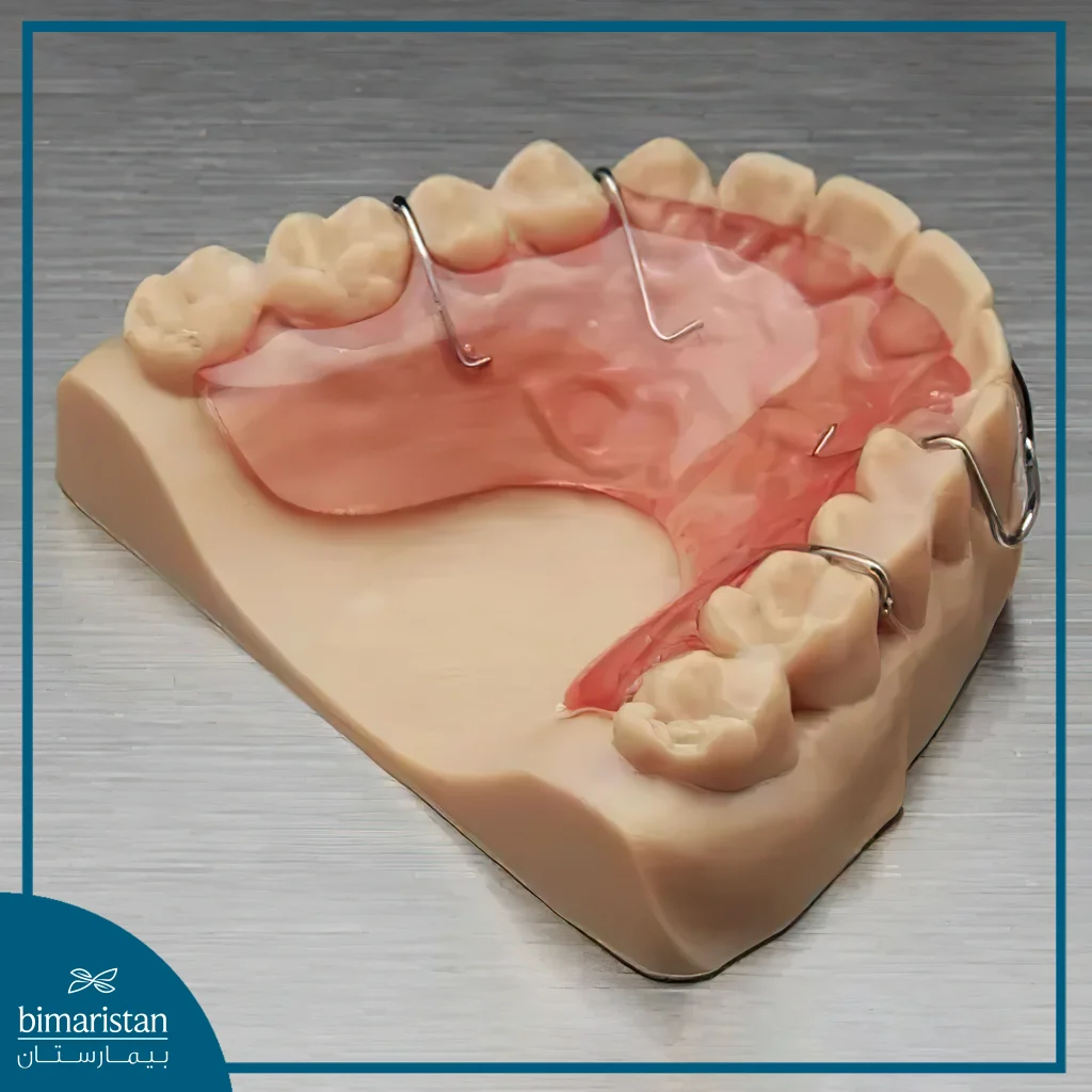 Post-Orthodontic Retainers For Overjet Treatment