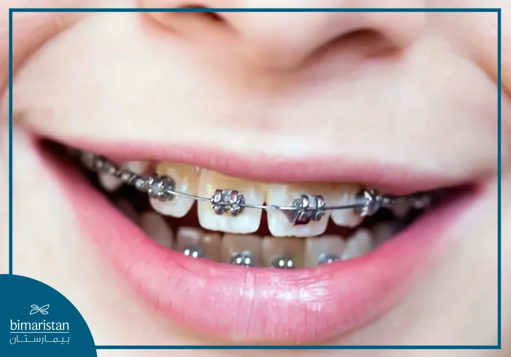 Treatment Of Crowded Teeth In Istanbul With Metal Braces