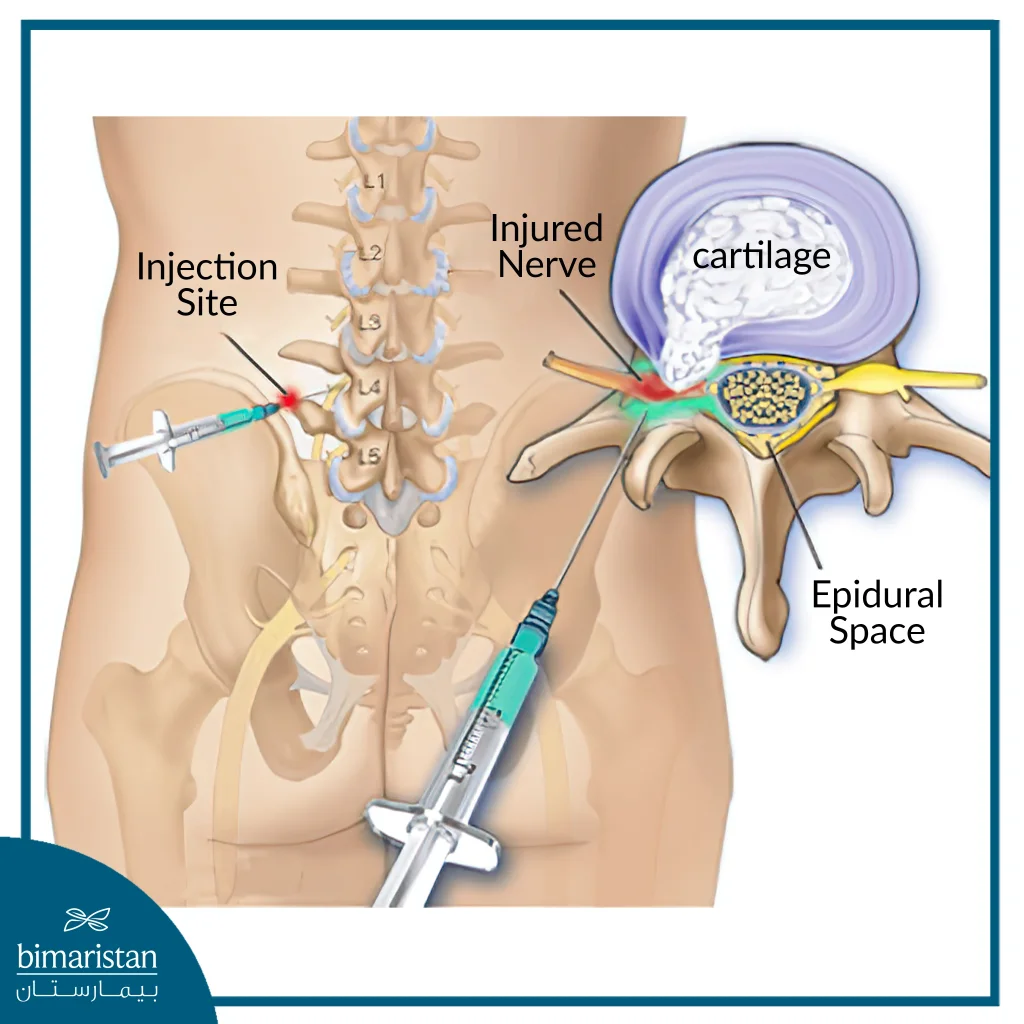 Epidural Steroid Injection In Turkey For Leg And Lower Back Pain