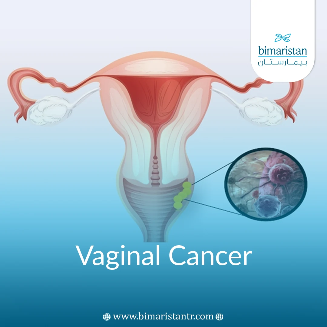 Vaginal Cancer